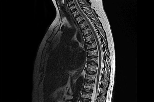 Manifestationen der thorakalen Osteochondrose im Bild der Magnetresonanztomographie
