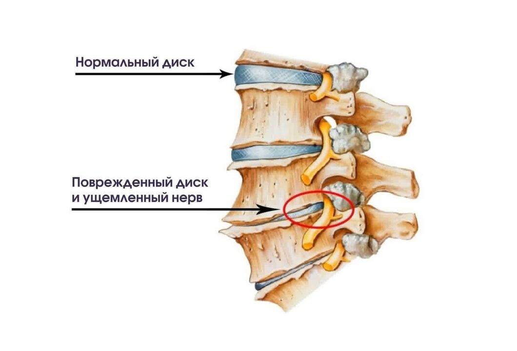 Symptome der Hals -Osteochondose