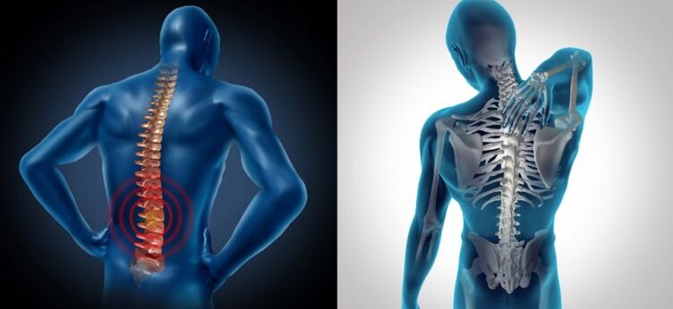 Entzündung bei spinaler Osteochondrose